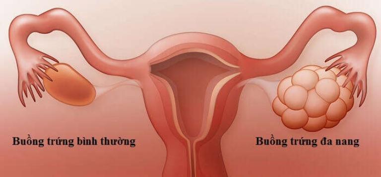 Chẩn Đoán PCOS - Tiêu Chí Và Quy Trình Khám